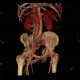 AV fistula, arteriovenous fistula in the leg: CT - Computed tomography